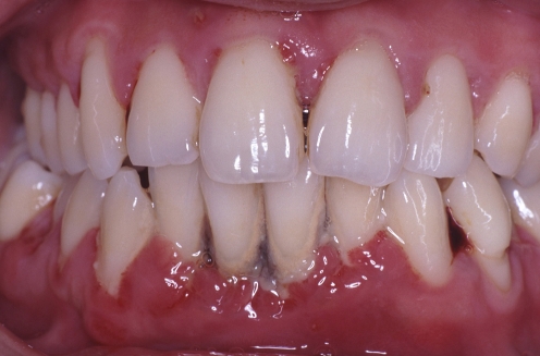 diabetes and your teeth